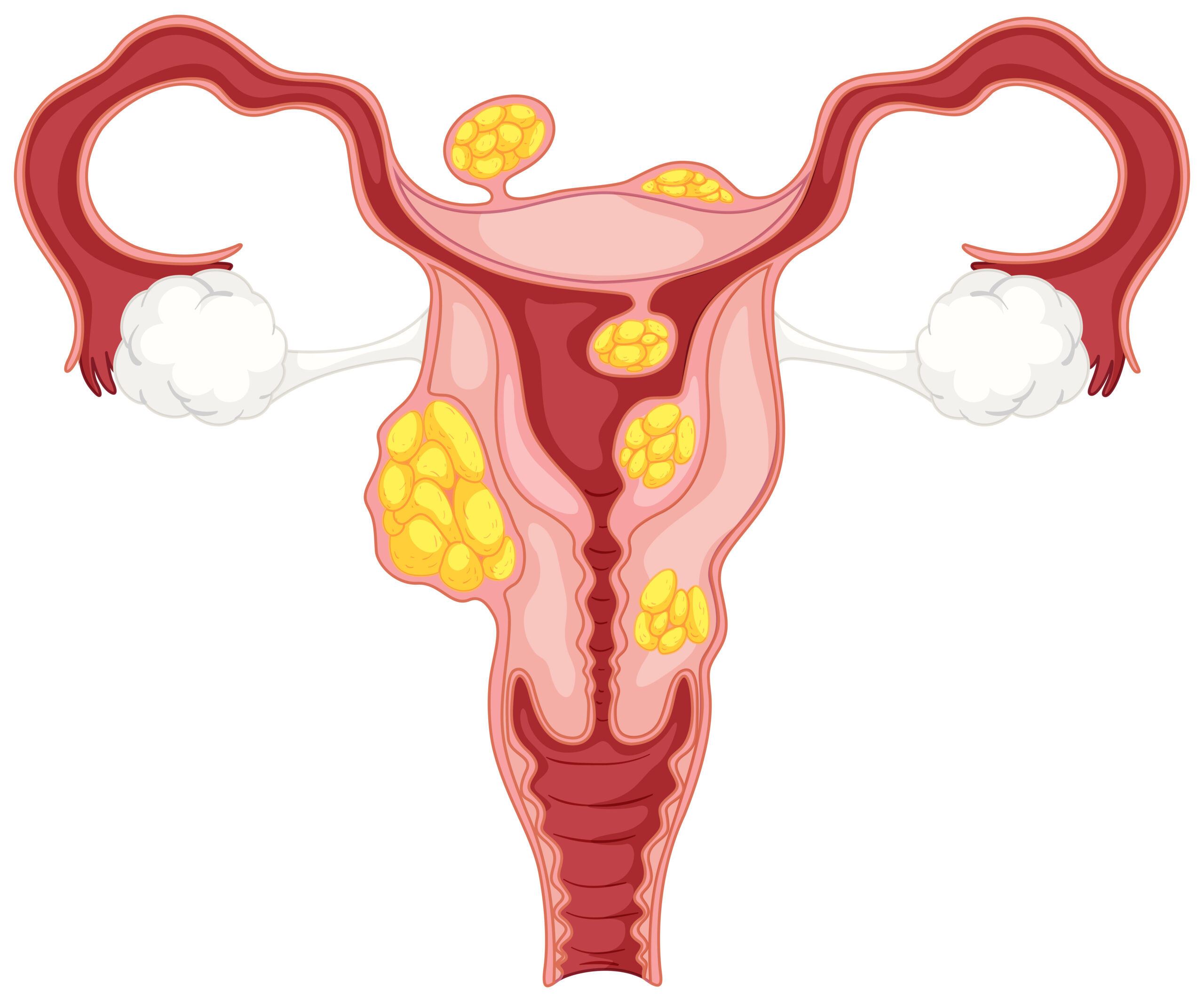Fibroids and Polyps