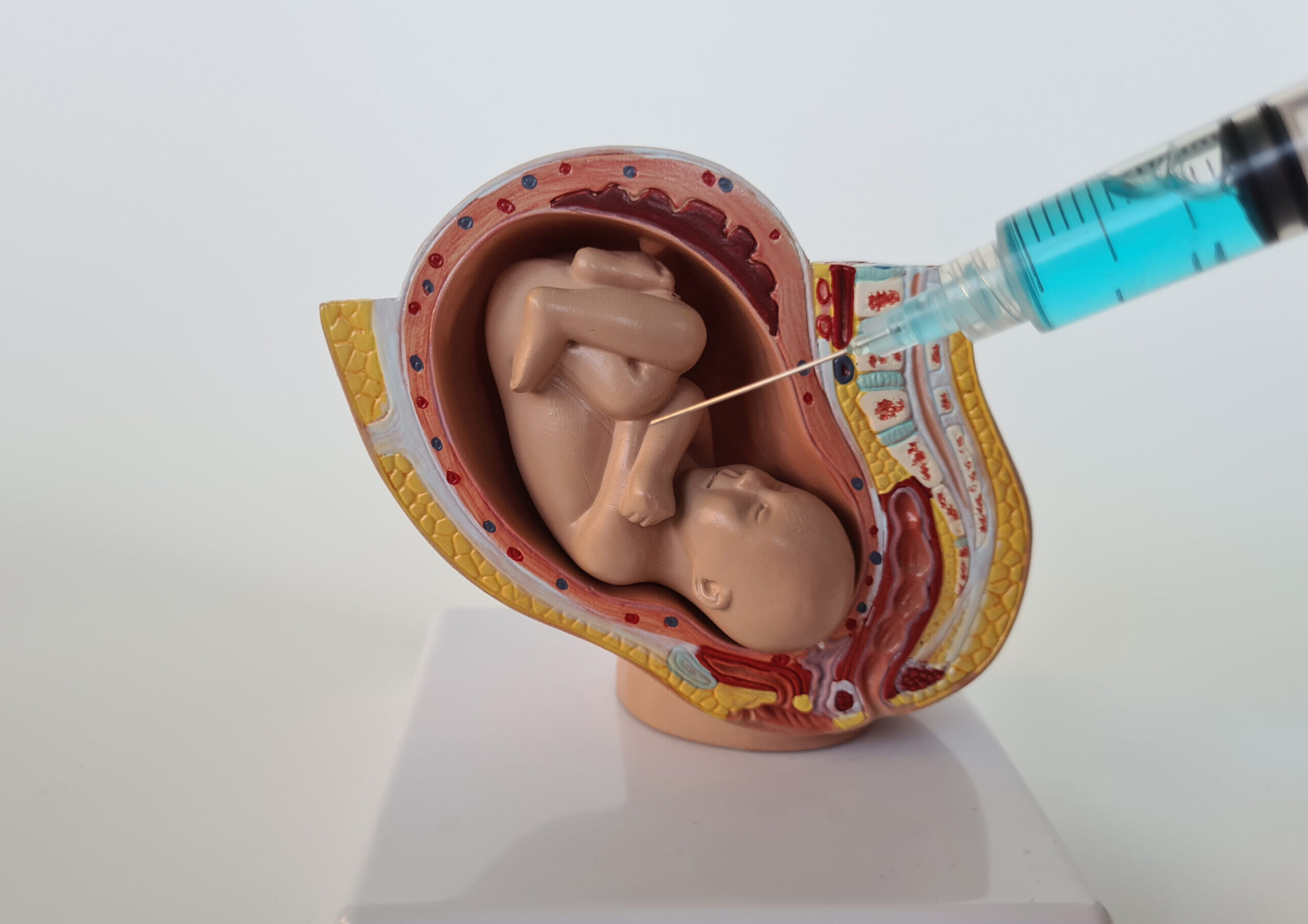 Amniocentesis and Chorionic Villus Sampling