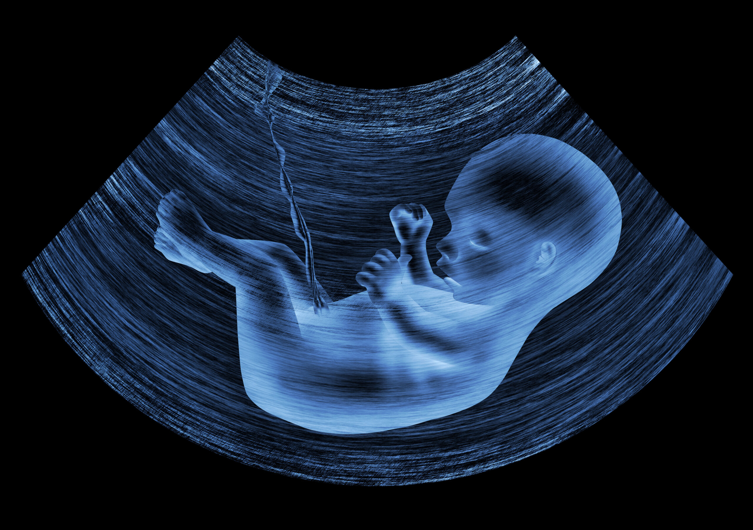 Nuchal Translucency