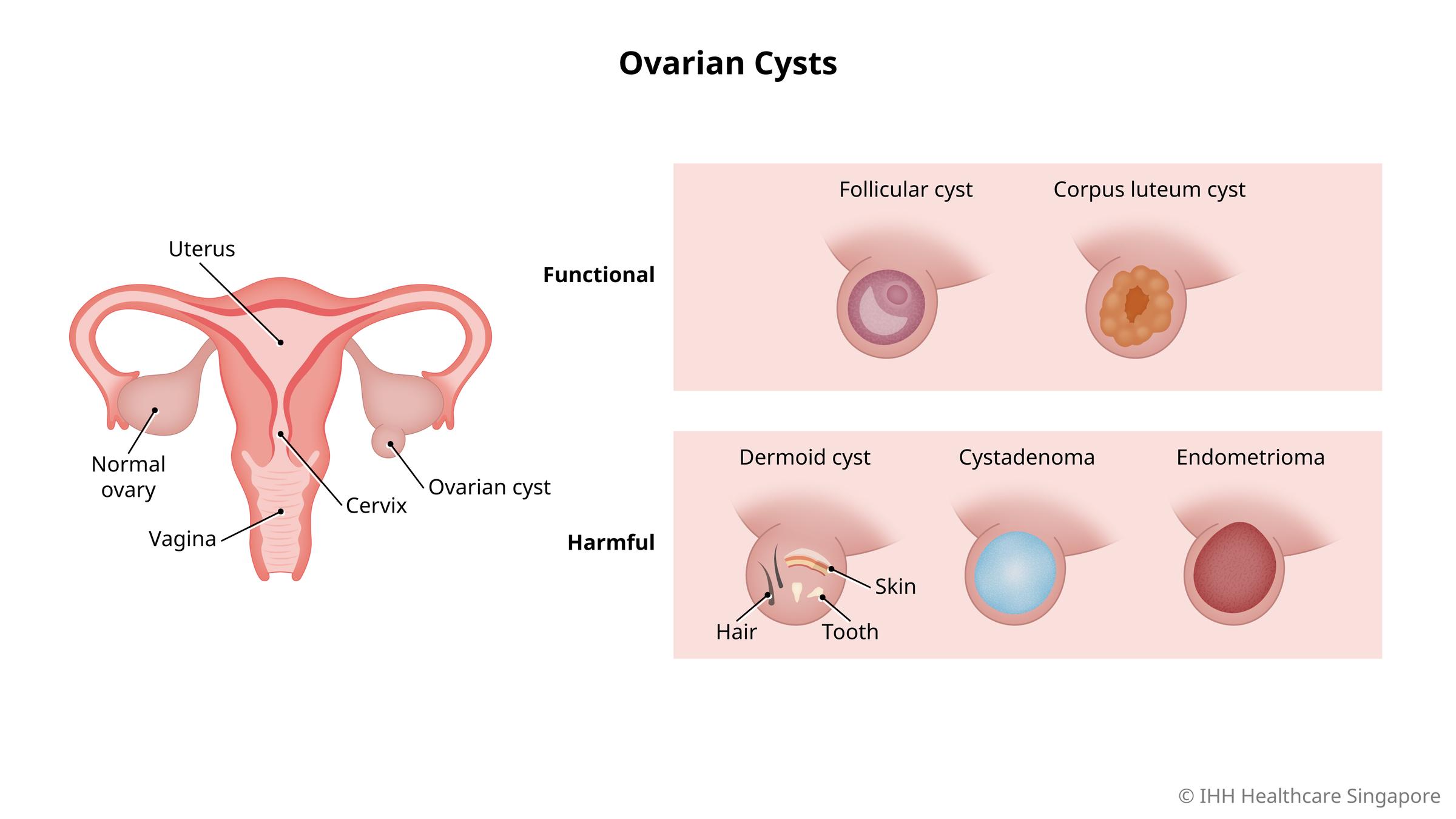 size of ovarian cyst