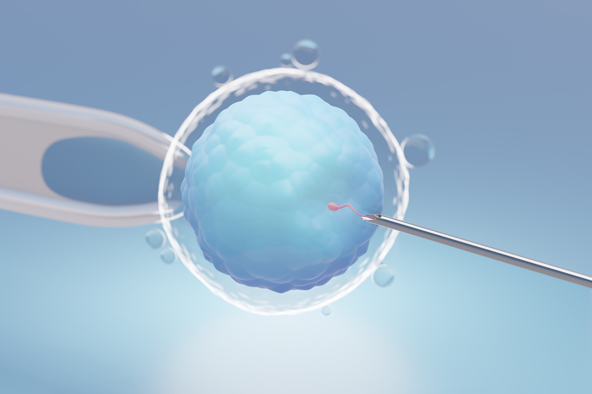 intracytoplasmic sperm injection