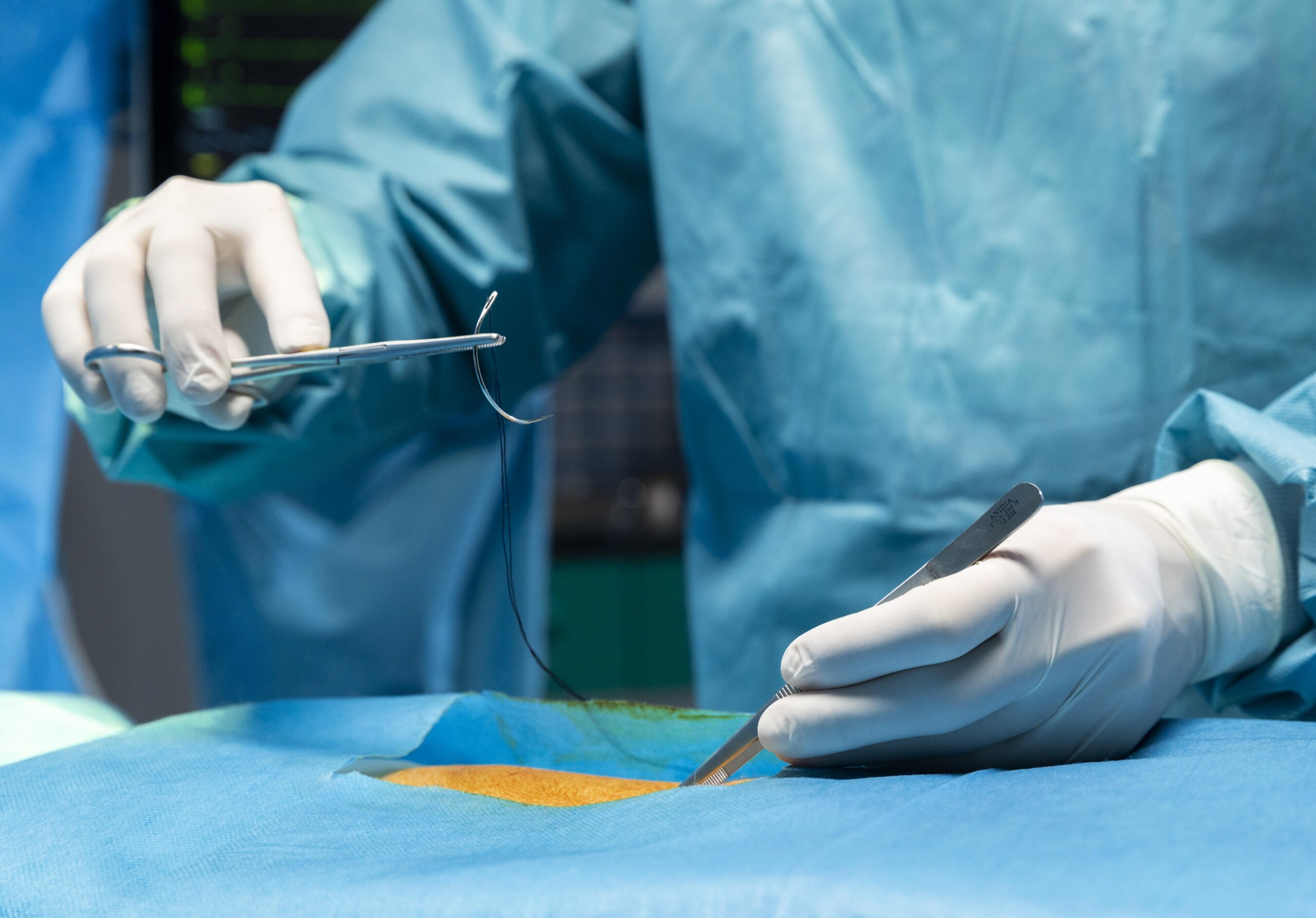 Laparoscopic colorectal surgery in Trivandrum